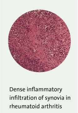 microscopic picture of inflammatory autoimmune TMA